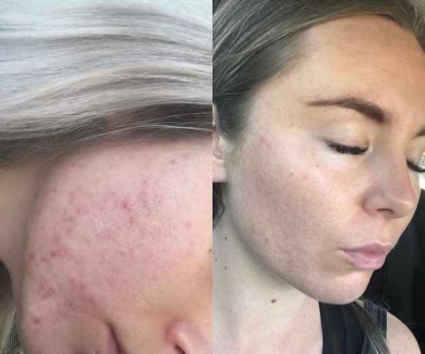 Why this ‘acne-preventing’ oil that leaves skin feeling like ‘silk’ is flying off shelves around the world