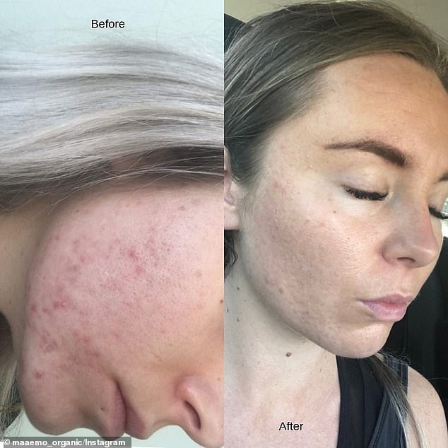 Why this ‘acne-preventing’ oil that leaves skin feeling like ‘silk’ is flying off shelves around the world