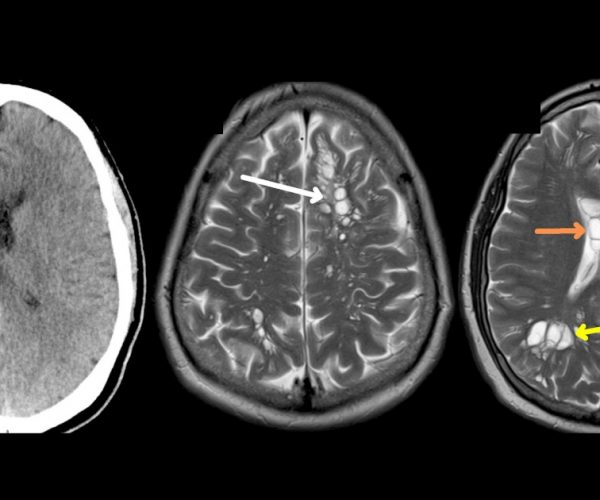 Man finds out migraines caused by brain tapeworms; undercooked bacon may be culprit